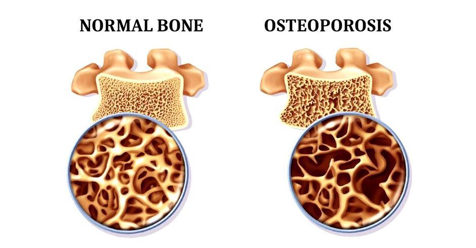 مواد غذایی مضر برای پوکی استخوان