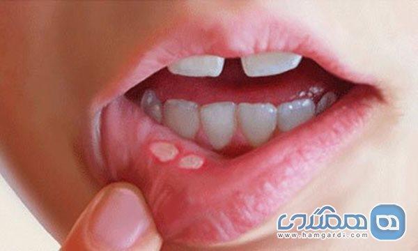 ارتباط سلامت روان و آفت دهان ارتباط سلامت روان و آفت دهان