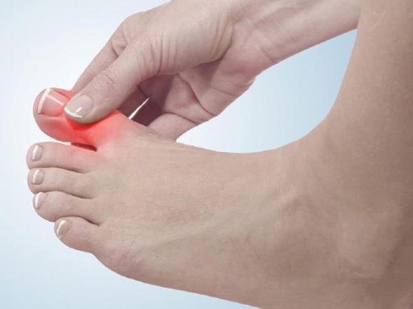 آنچه باید درباره بیماری نقرس بدانید آنچه باید درباره بیماری نقرس بدانید